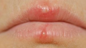 Hiện tượng xăm môi lên mụn nước xuất hiện rất phổ biến