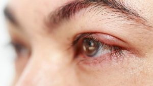 Sưng mí mắt còn có nhiều dấu hiệu khác kèm theo
