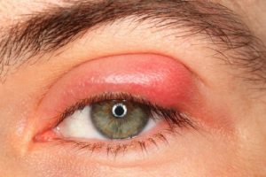 Viêm bờ mi mắt là trình trạng mí mắt sưng phồng và viêm đỏ
