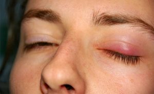 Mí mắt sưng thường đem lại cảm giác khó chịu về nhiều mặt
