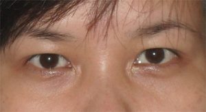 Mỡ mí mắt “đại diện” cho lão hóa da