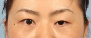 Mắt sụp mí gây mất tự tin cho phái đẹp