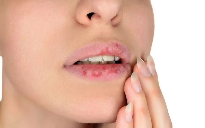 Không dùng tay gỡ lớp vảy trên môi