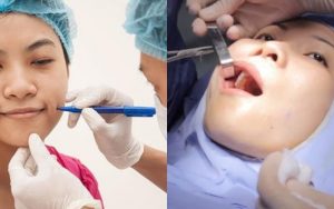 Tạo má lúm là một thủ thuật làm đẹp đơn giản, nhanh phục hồi