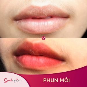 Cùng tìm hiểu khử thâm môi và phun môi khác nhau như thế nào