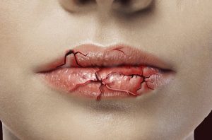 Kỹ thuật viên tay nghề yếu khiến môi bạn bị bong nhiều lần sau phun xăm