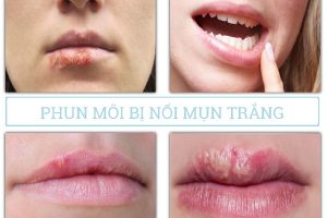 Tình trạng sau khi phun môi bị nổi mụn trắng