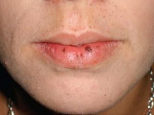 Xăm môi bị chấm đen không quá nguy hiểm nếu được xử lý kịp thời