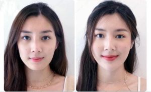 Gương mặt trở nên xinh đẹp, quyến rũ và tươi trẻ hơn sau khi thực hiện tiêm filler