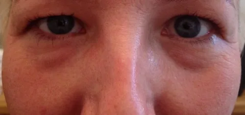 Hiểu lầm phổ biến về đau nhức sau tiêm filler