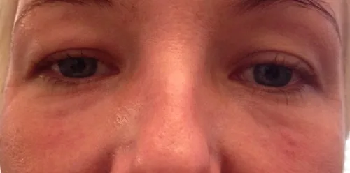 Vì sao không được massage sau tiêm filler