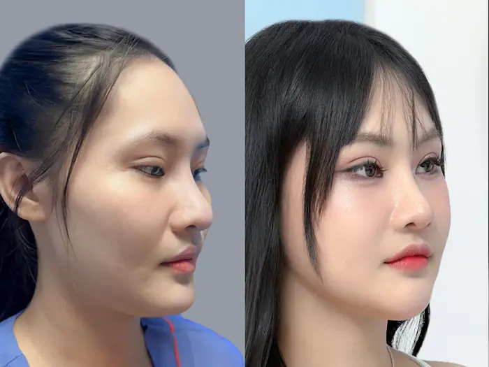Tại sao phẫu thuật gò má lại khiến miệng khó há?