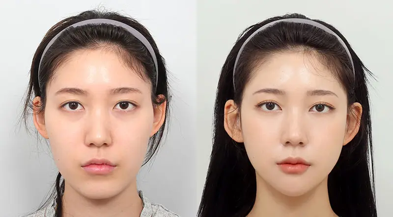 Hạ gò má bao lâu hết sưng