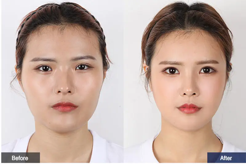 Hạ gò má