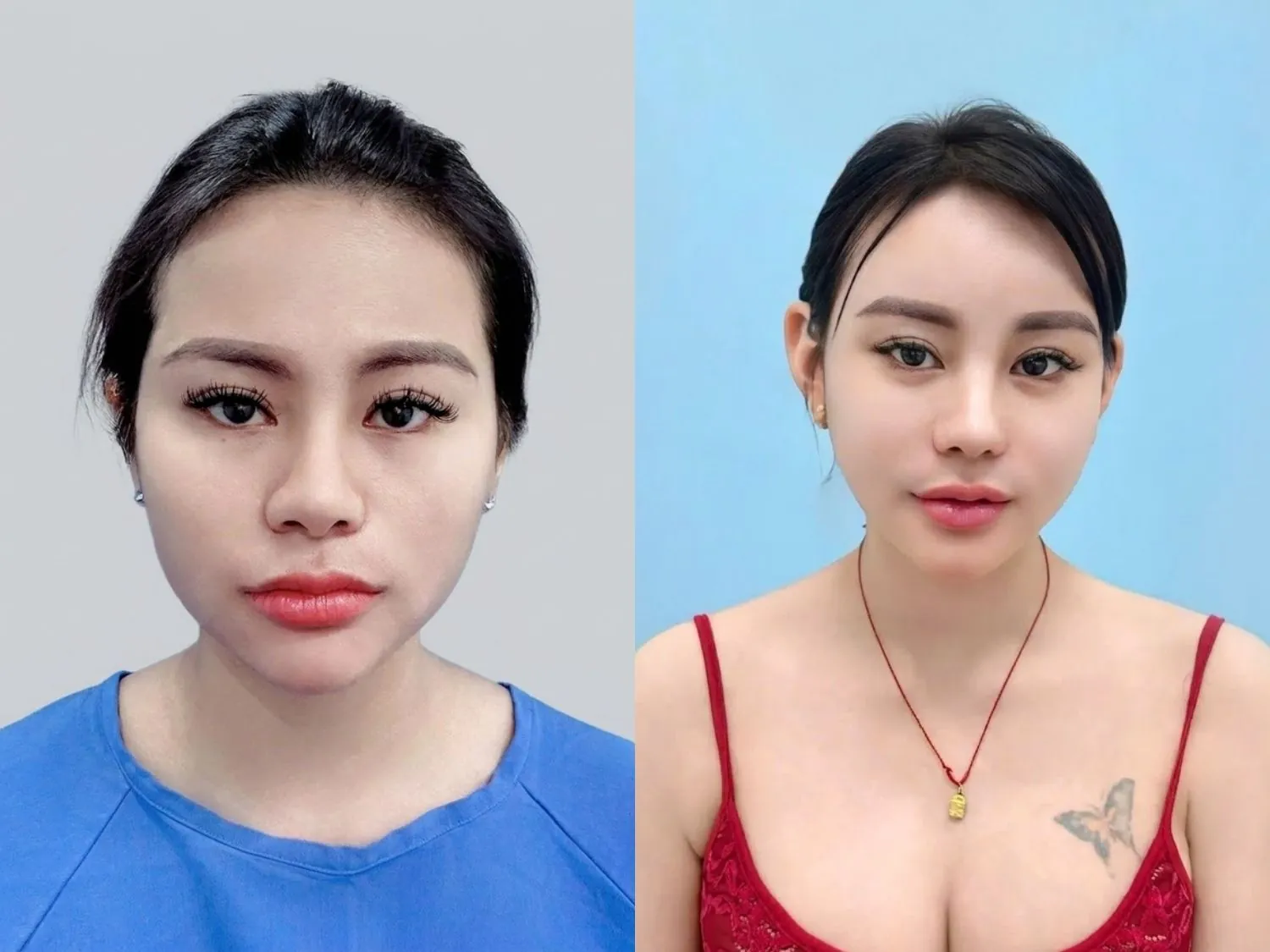 Tê bì sau hạ gò má là hiện tượng bình thường
