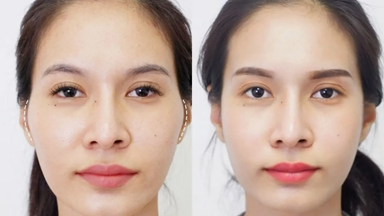 Ai nên làm phẫu thuật hạ gò má?