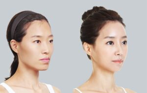 Làm thế nào để phòng chống và khắc phục chảy xệ?