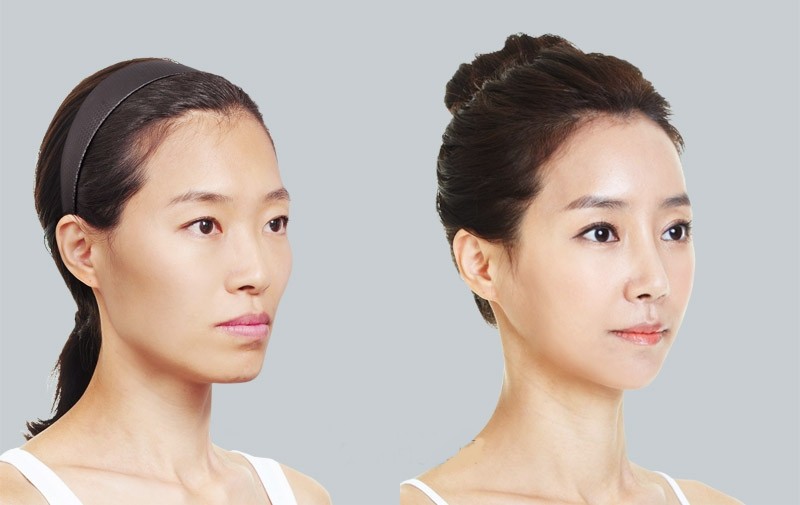 Làm thế nào để phòng chống và khắc phục chảy xệ?