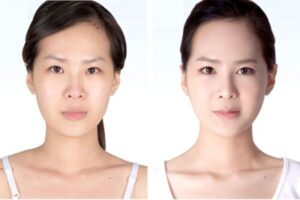 Làm thế nào để kéo dài tuổi thọ filler?