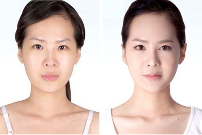 Làm thế nào để kéo dài tuổi thọ filler?