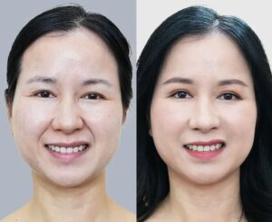 Tiêm filler má có làm mặt bị đơ cứng