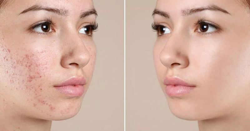 Dầu Oliu có đặc tính kháng viêm, giúp giảm sưng tấy hỗ trợ điều trị mụn