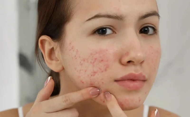 Da mụn có thể dùng dầu oliu rửa mặt để hỗ trợ điều trị mụn hiệu quả
