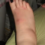 nail allergic reaction