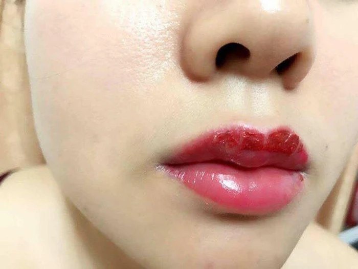 Laser có khắc phục được lem viền môi không?