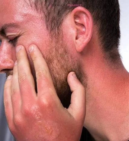 Cháy nắng mặt là gì và triệu chứng nhận biết?