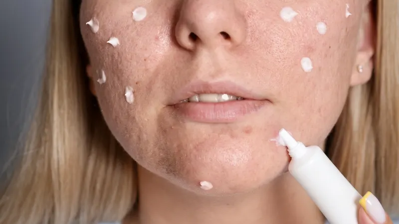 Tại sao chăm sóc da mụn ban ngày không thể giống buổi tối?