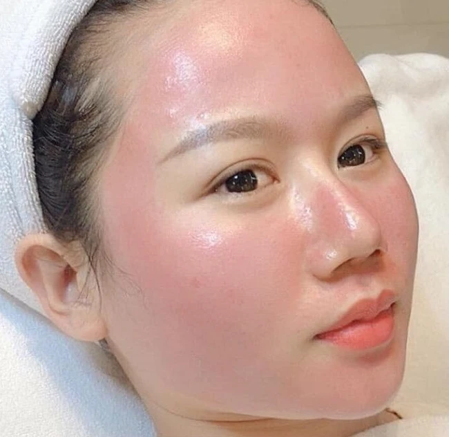 Ai nên lăn kim, ai không nên?