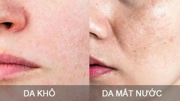 Nên chăm sóc da khô và da thiếu nước như thế nào?