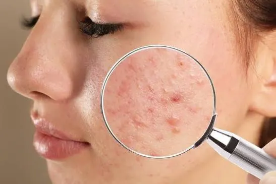 Cách phân biệt purging và kích ứng qua các dấu hiệu?