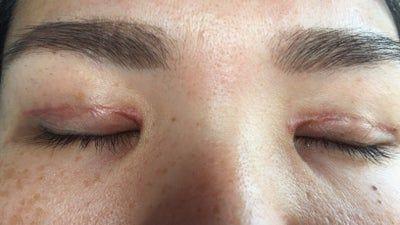Nhanh hay chậm tùy vào cơ địa cá nhân. Người có da trắng thường hồi phục nhanh hơn người da tối.