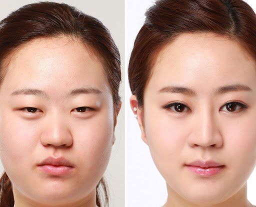 Cắt mí làm đôi mắt trông to tròn, sáng và có hồn hơn