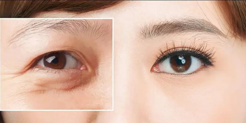 Chuyển từ mắt mí lót thành mắt 2 mí rõ ràng giúp đôi mắt trông to tròn, cân đối, có chiều sâu