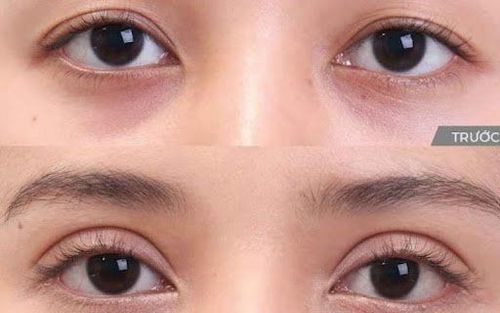 bác sĩ kiểm tra đối xứng, điều chỉnh vị trí nếp mí, và đảm bảo kết quả tự nhiên.