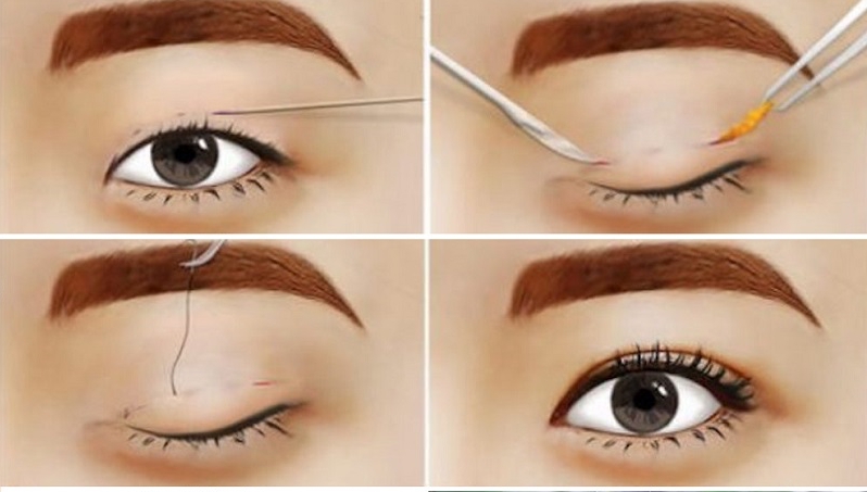 Công nghệ hiện đại như nội soi, laser, hay plasma có thể tạo nếp mí chính xác