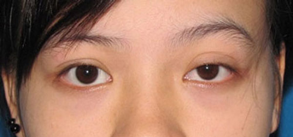 mí mắt không đều làm cho người khác dễ nhận thấy sự chênh lệch giữa hai bên