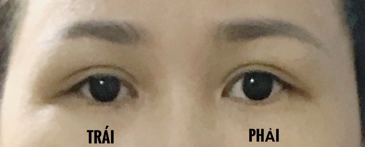 Cắt mí lỗi hay hỏng hoàn toàn có biện pháp khắc phục