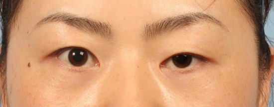 Nếu bác sĩ nhận thấy sớm tín hiệu mí không đều, họ có thể điều chỉnh trong những tuần đầu, tránh tình huống tệ hơn.