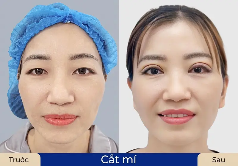 Cơ địa ảnh hưởng đến thời gian cắt mí lành lại