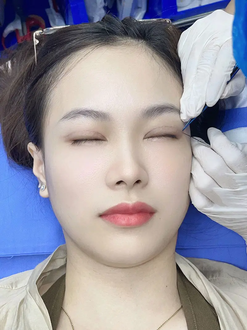 Nếu bác sĩ tay nghề yếu, nguy cơ để lại sẹo cao với vết sẹo lớn và các biến chứng như mí bị lệch, quá to, hoặc quá nhỏ