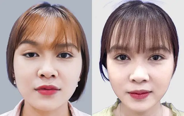 Từ tuần thứ 2 đến tuần thứ 4, nếp mí bắt đầu gom lại và hình dáng trở nên cụ thể hơn