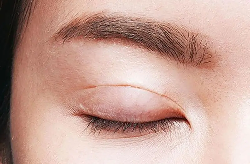 Giai đoạn đầu (1-2 tháng), vết sẹo vẫn còn hơi đỏ, có thể hơi sưng và có cảm giác lơi lỏng