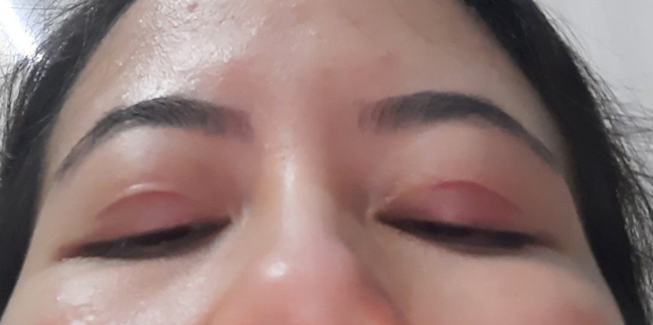 Sẹo trắng (hay sẹo giảm sắc tố) là một loại sẹo phẳng có màu trắng hoặc nhạt hơn so với vùng da xung quanh