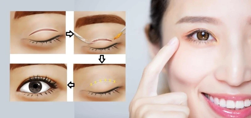 Sau 12 tháng, phần lớn mọi người sẽ không còn nhận ra vết sẹo cắt mí của họ, khi nó hoàn toàn biến mất như chưa từng có phẫu thuật.