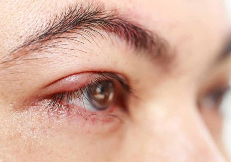 Bị sẹo lồi sau cắt mí có thể sửa được