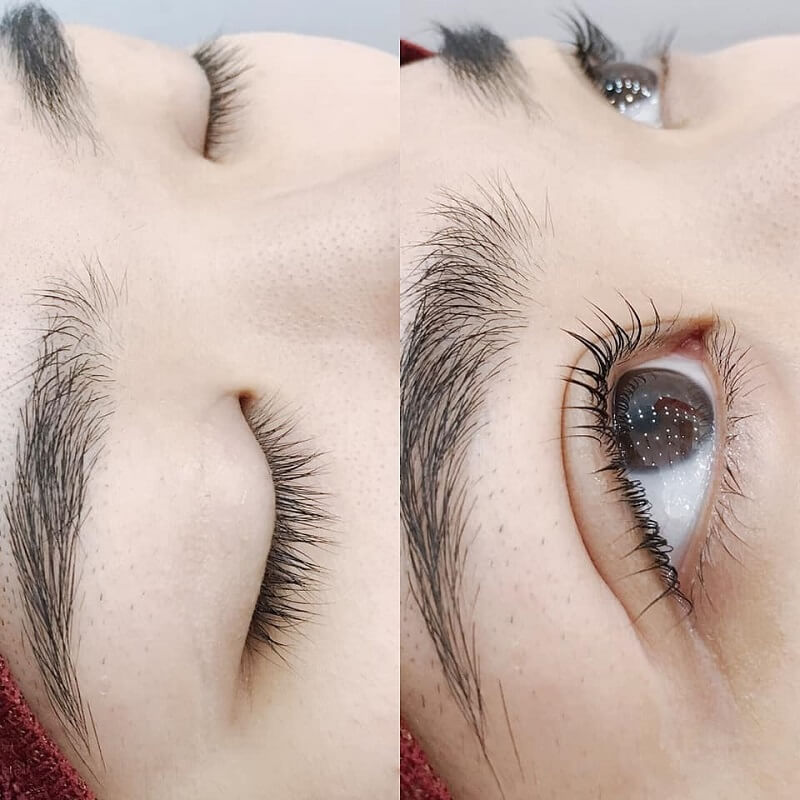 Quy trình cắt mí 4D thường có thể tóm thành sáu bước